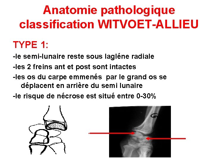 Anatomie pathologique classification WITVOET-ALLIEU TYPE 1: -le semi-lunaire reste sous lagléne radiale -les 2