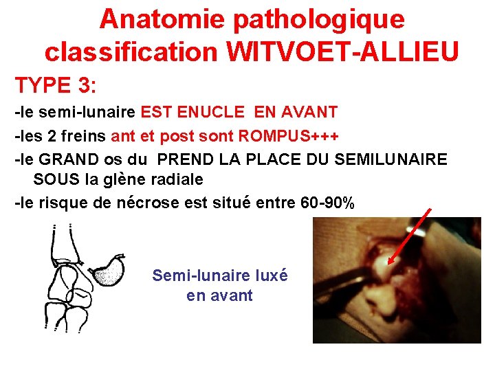 Anatomie pathologique classification WITVOET-ALLIEU TYPE 3: -le semi-lunaire EST ENUCLE EN AVANT -les 2