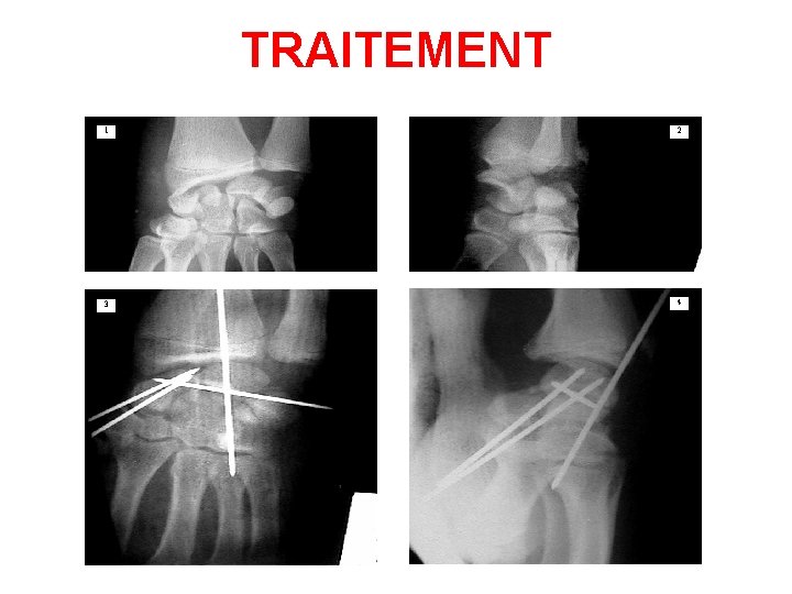 TRAITEMENT 1 2 3 4 