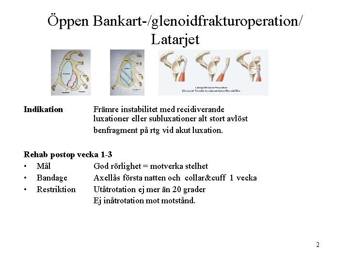 Öppen Bankart-/glenoidfrakturoperation/ Latarjet Indikation Främre instabilitet med recidiverande luxationer eller subluxationer alt stort avlöst