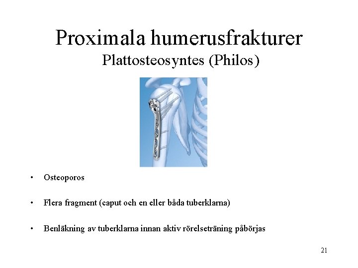 Proximala humerusfrakturer Plattosteosyntes (Philos) • Osteoporos • Flera fragment (caput och en eller båda
