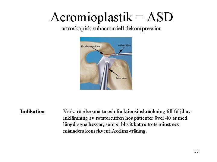 Acromioplastik = ASD artroskopisk subacromiell dekompression Indikation Värk, rörelsesmärta och funktionsinskränkning till följd av