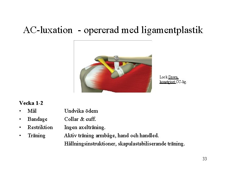 AC-luxation - opererad med ligamentplastik Lock Down, konstgjort CC-lig. Vecka 1 -2 • Mål