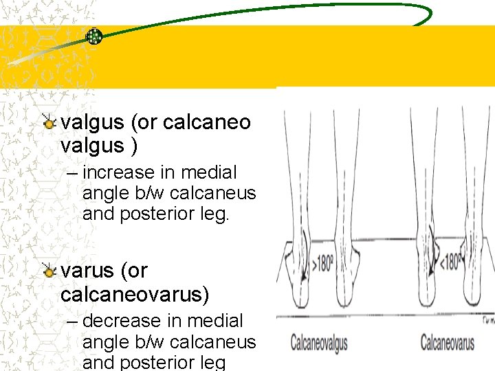 valgus (or calcaneo valgus ) – increase in medial angle b/w calcaneus and posterior