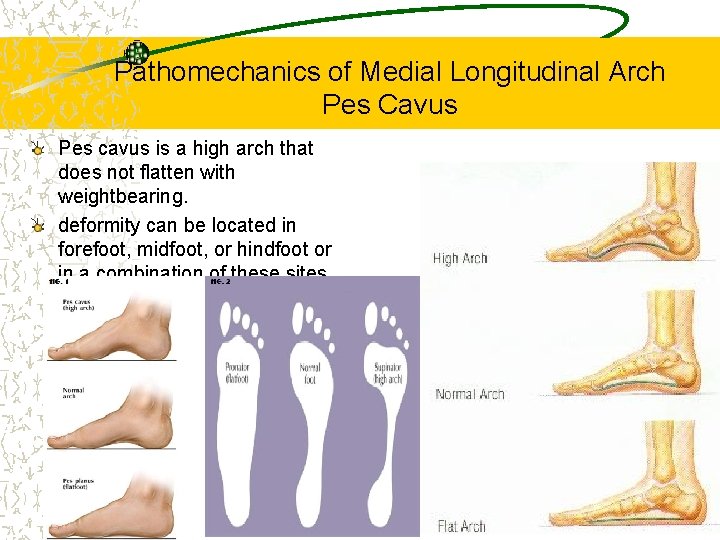 Pathomechanics of Medial Longitudinal Arch Pes Cavus Pes cavus is a high arch that