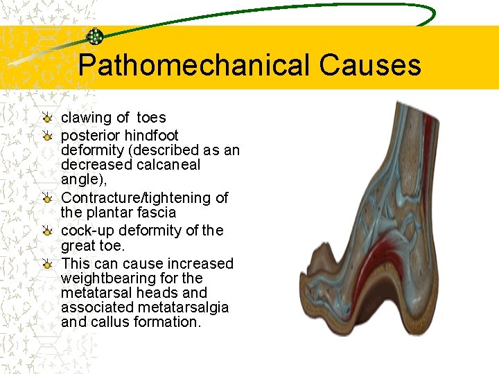 Pathomechanical Causes clawing of toes posterior hindfoot deformity (described as an decreased calcaneal angle),