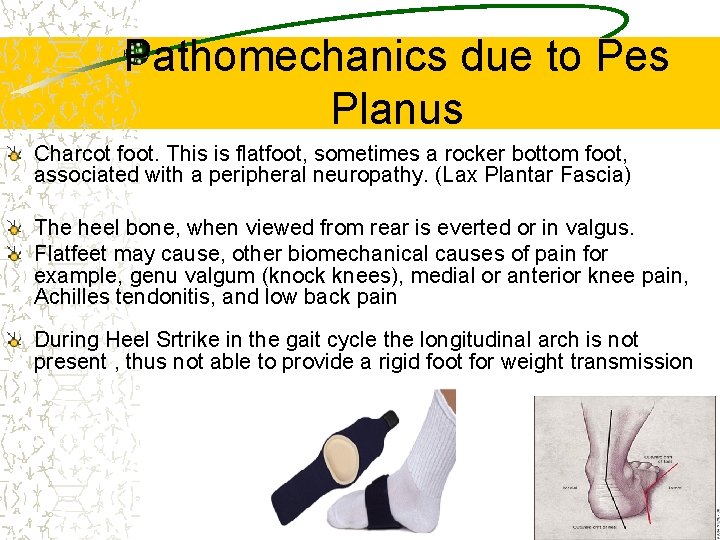 Pathomechanics due to Pes Planus Charcot foot. This is flatfoot, sometimes a rocker bottom