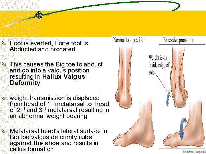 Foot is everted, Forte foot is Abducted and pronated This causes the Big toe