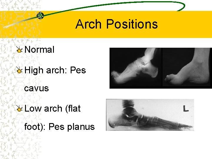 Arch Positions Normal High arch: Pes cavus Low arch (flat foot): Pes planus 