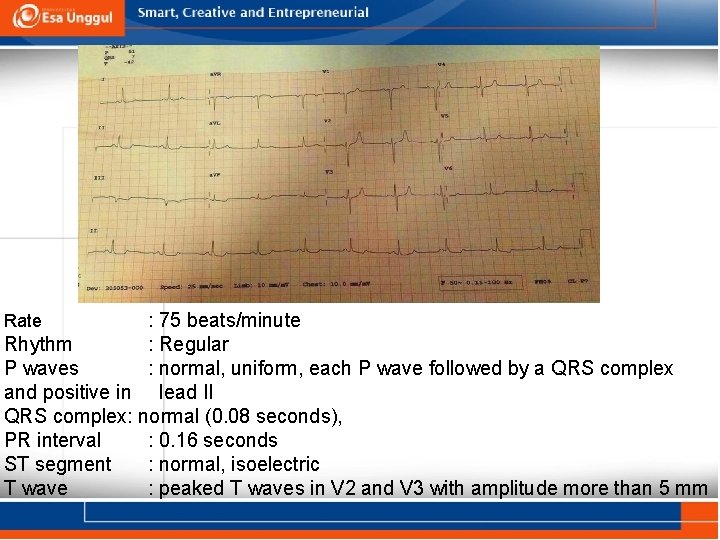 : 75 beats/minute Rhythm : Regular P waves : normal, uniform, each P wave