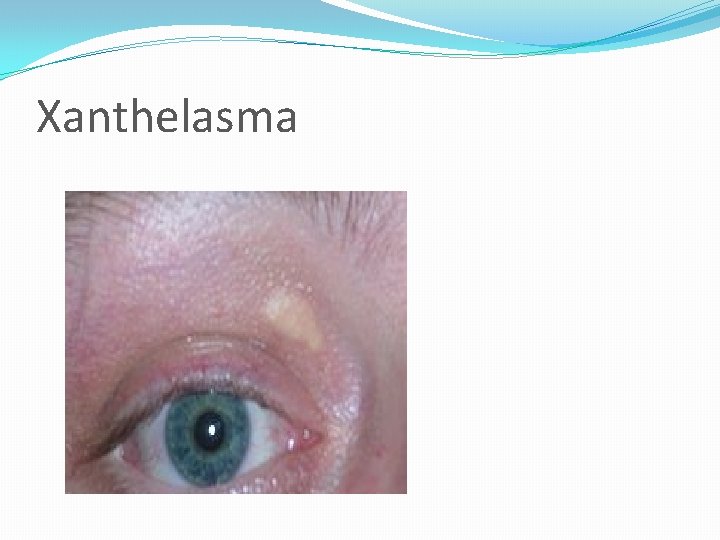 Xanthelasma 