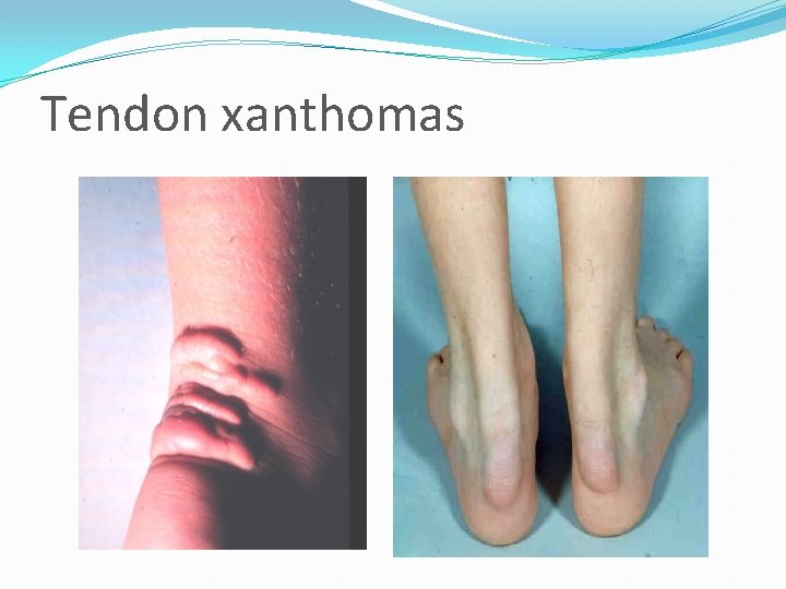 Tendon xanthomas 