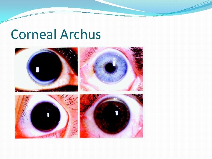 Corneal Archus 