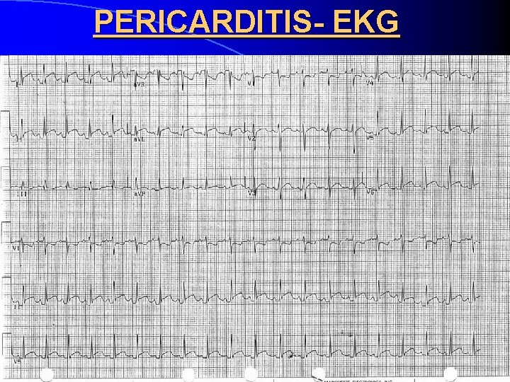 PERICARDITIS- EKG 
