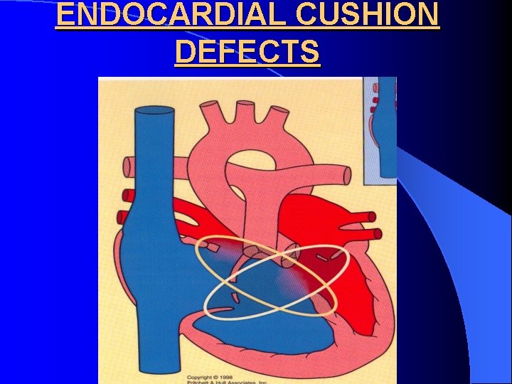 ENDOCARDIAL CUSHION DEFECTS 