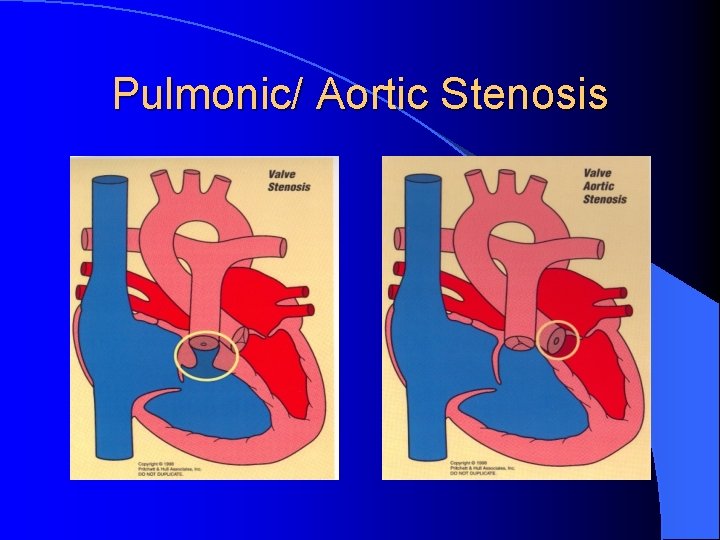 Pulmonic/ Aortic Stenosis 