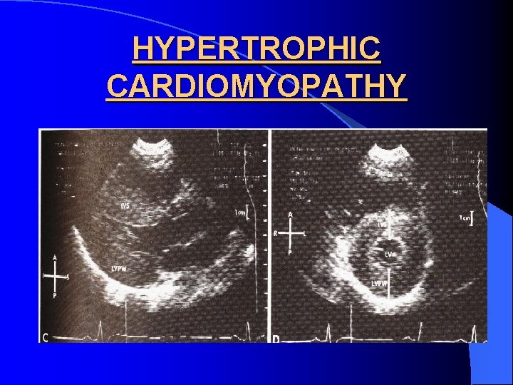 HYPERTROPHIC CARDIOMYOPATHY 