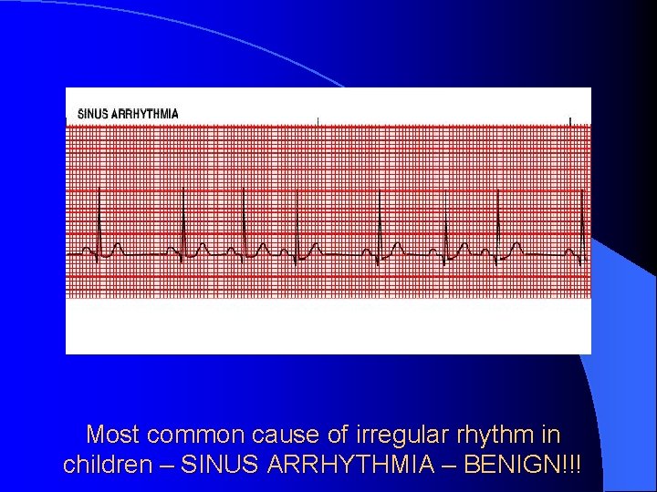 Most common cause of irregular rhythm in children – SINUS ARRHYTHMIA – BENIGN!!! 
