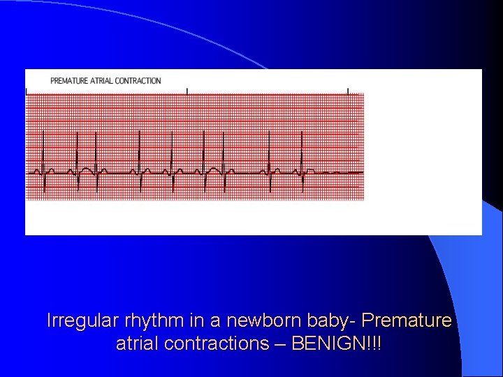 Irregular rhythm in a newborn baby- Premature atrial contractions – BENIGN!!! 