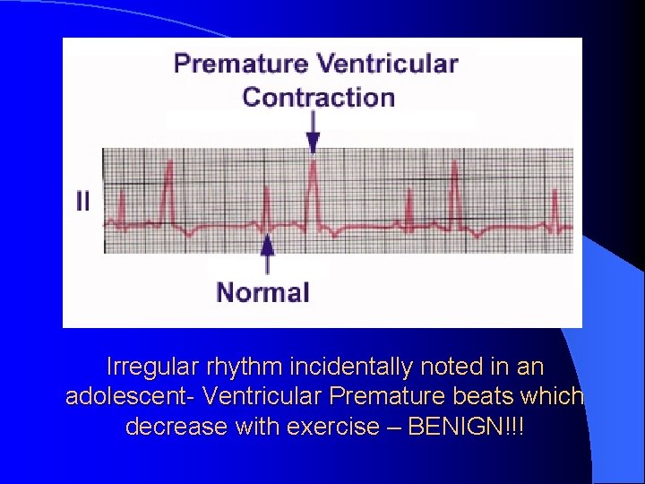 Irregular rhythm incidentally noted in an adolescent- Ventricular Premature beats which decrease with exercise