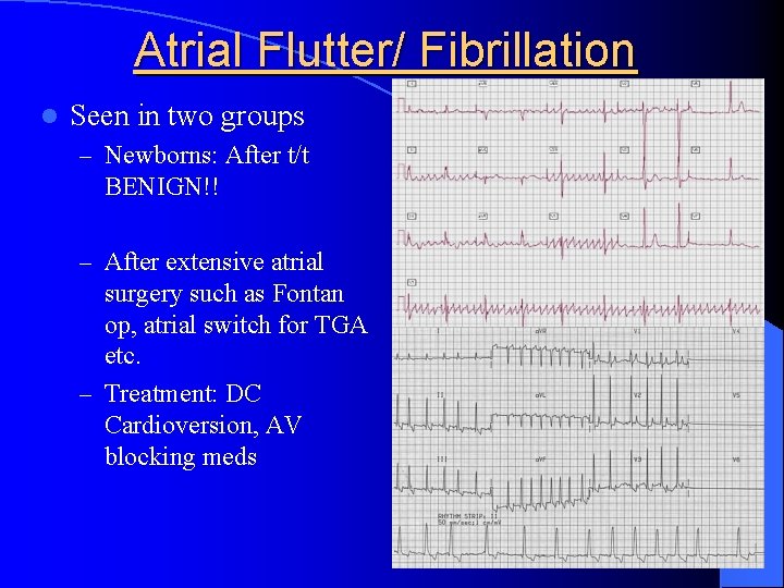 Atrial Flutter/ Fibrillation l Seen in two groups – Newborns: After t/t BENIGN!! –