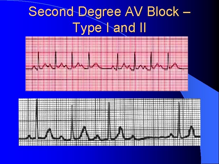 Second Degree AV Block – Type I and II 