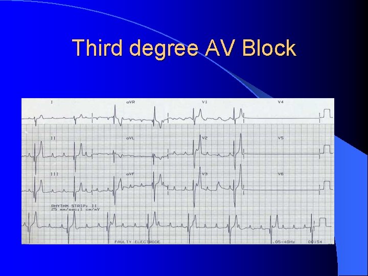 Third degree AV Block 