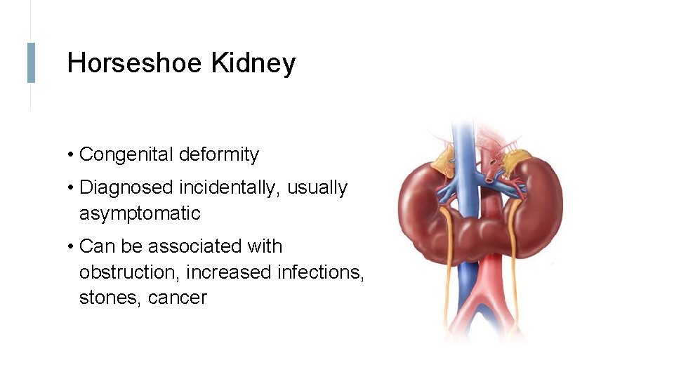 Horseshoe Kidney • Congenital deformity • Diagnosed incidentally, usually asymptomatic • Can be associated