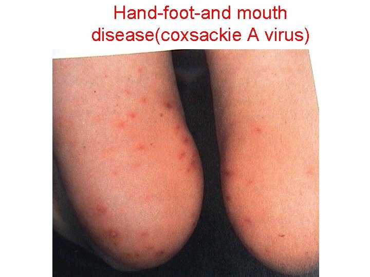 Hand-foot-and mouth disease(coxsackie A virus) DP MONGA DMIP, FOM, AAU 