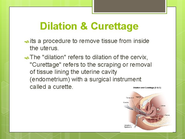 Dilation & Curettage its a procedure to remove tissue from inside the uterus. The