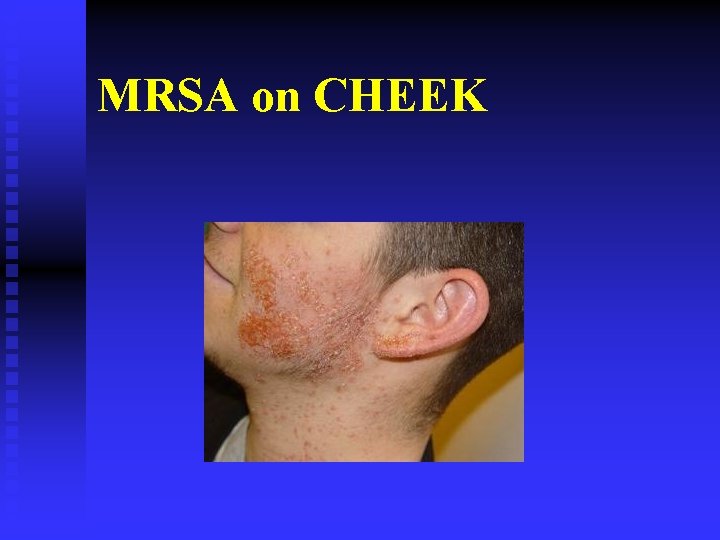 MRSA on CHEEK 