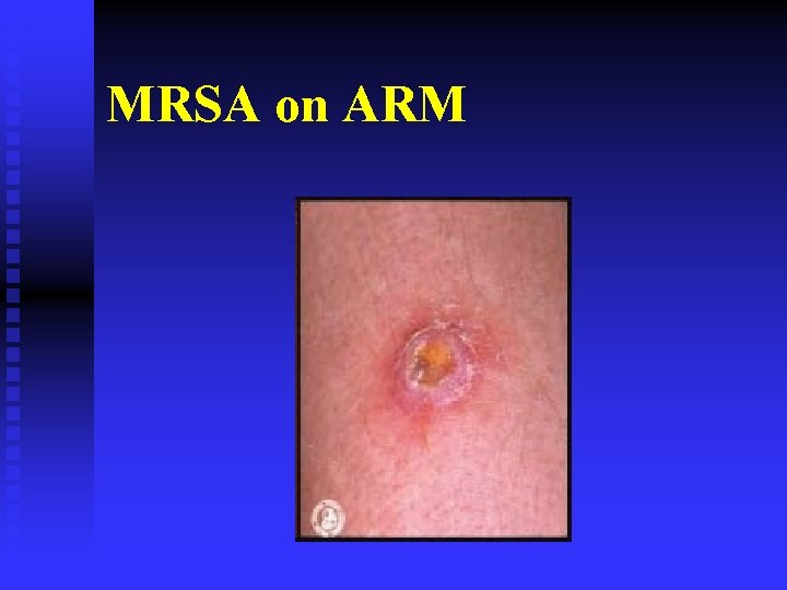 MRSA on ARM 