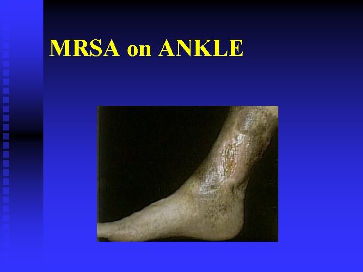 MRSA on ANKLE 