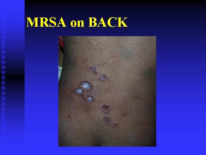 MRSA on BACK 