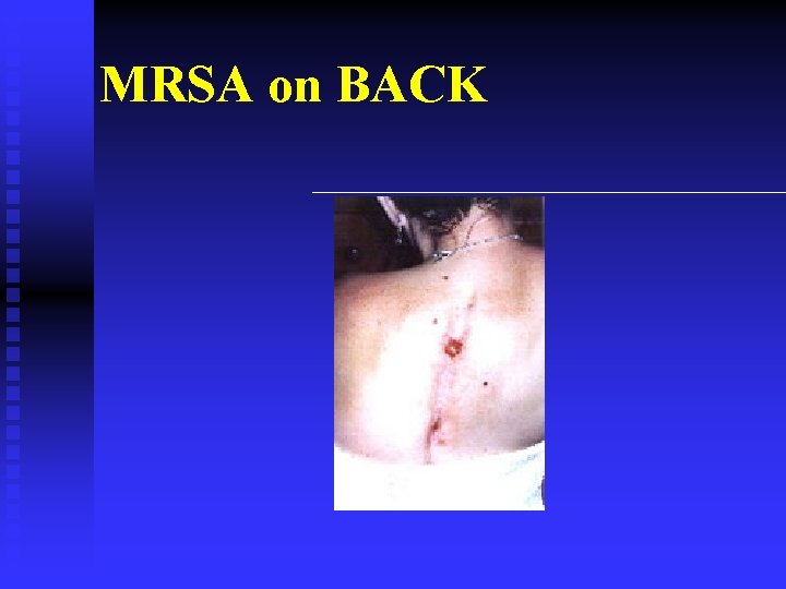 MRSA on BACK 