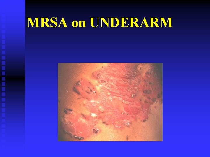 MRSA on UNDERARM 