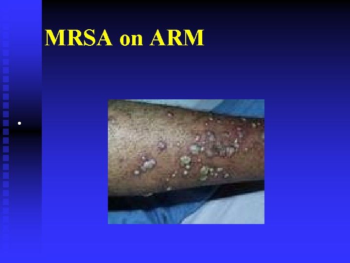 MRSA on ARM • 