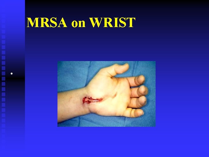 MRSA on WRIST • 