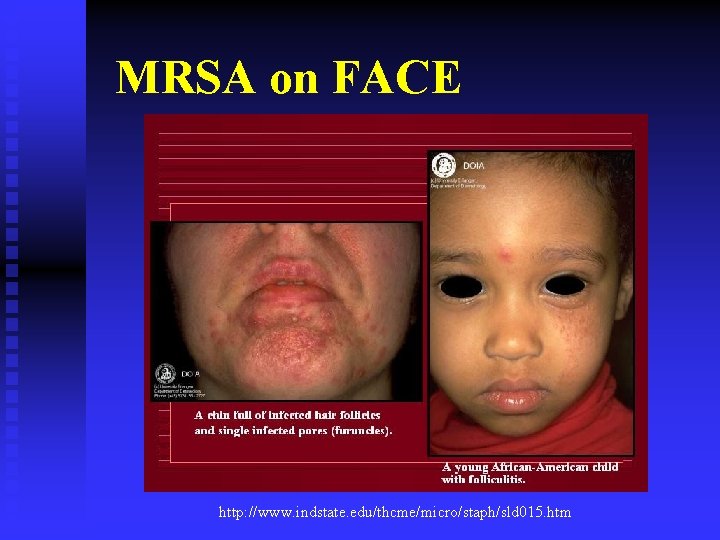 MRSA on FACE http: //www. indstate. edu/thcme/micro/staph/sld 015. htm 