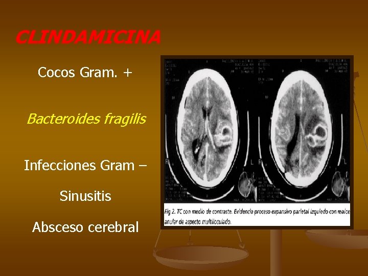 CLINDAMICINA Cocos Gram. + Bacteroides fragilis Infecciones Gram – Sinusitis Absceso cerebral 