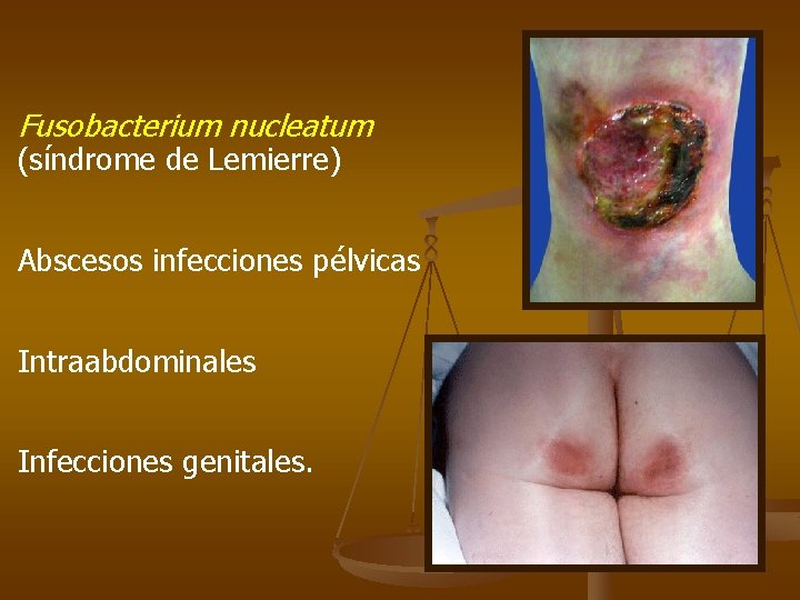 Fusobacterium nucleatum (síndrome de Lemierre) Abscesos infecciones pélvicas Intraabdominales Infecciones genitales. 