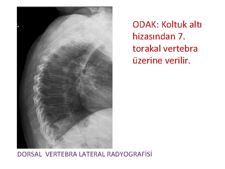 ODAK: Koltuk altı hizasından 7. torakal vertebra üzerine verilir. DORSAL VERTEBRA LATERAL RADYOGRAFİSİ 