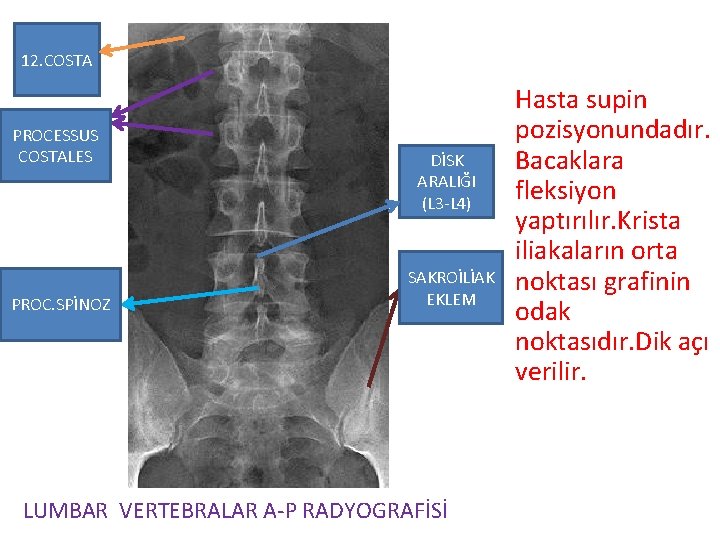 12. COSTA PROCESSUS COSTALES PROC. SPİNOZ DİSK ARALIĞI (L 3 -L 4) SAKROİLİAK EKLEM