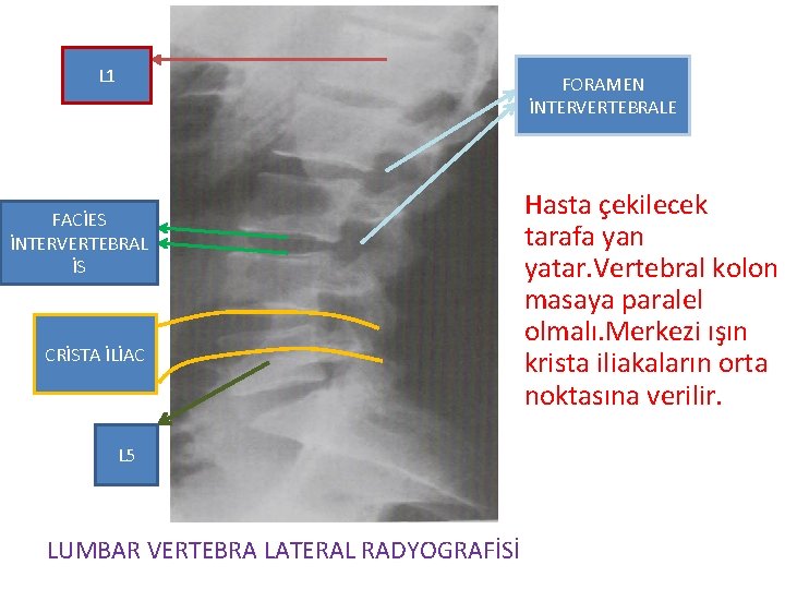 L 1 FORAMEN İNTERVERTEBRALE FACİES İNTERVERTEBRAL İS CRİSTA İLİAC L 5 LUMBAR VERTEBRA LATERAL