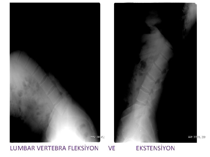 LUMBAR VERTEBRA FLEKSİYON VE EKSTENSİYON 