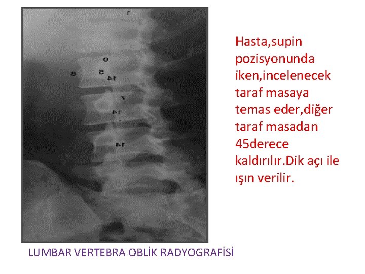 Hasta, supin pozisyonunda iken, incelenecek taraf masaya temas eder, diğer taraf masadan 45 derece