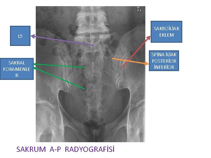 L 5 SAKRAL FORAMENLE R SAKRUM A-P RADYOGRAFİSİ SAKROİLİAK EKLEM SPİNA İLİAK POSTERİOR İNFERİOR