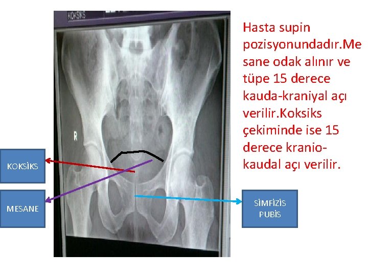 KOKSİKS MESANE Hasta supin pozisyonundadır. Me sane odak alınır ve tüpe 15 derece kauda-kraniyal