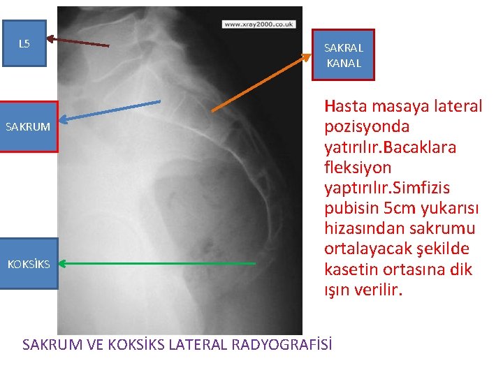 L 5 SAKRUM KOKSİKS SAKRAL KANAL Hasta masaya lateral pozisyonda yatırılır. Bacaklara fleksiyon yaptırılır.