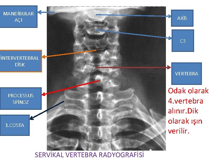 MANDİBULAR AÇI AXİS C 3 İNTERVERTEBRAL DİSK VERTEBRA Odak olarak 4. vertebra alınır. Dik